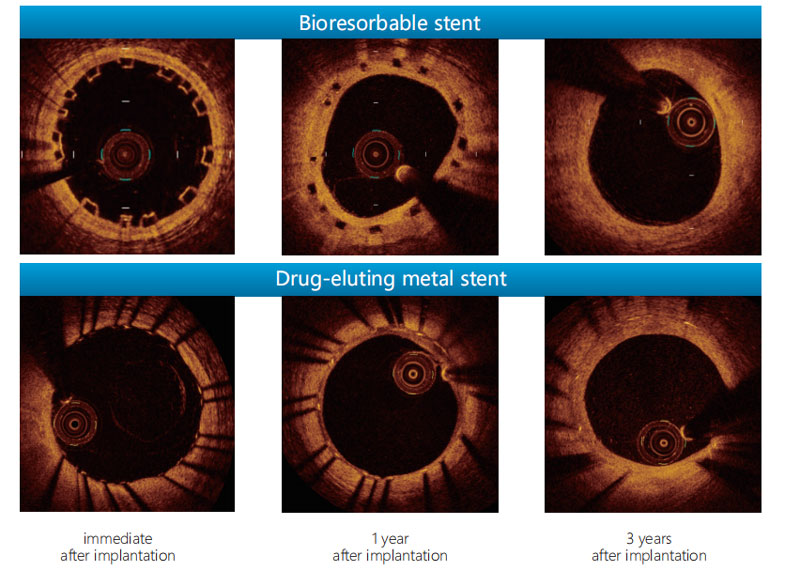 OCT-Study-on-stent-absorption-in-3-years.jpg