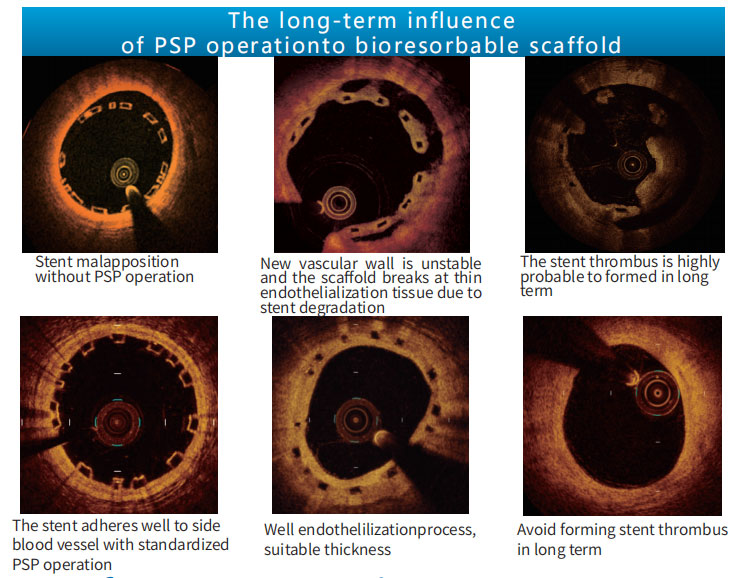 Why-PSP-operation-significantly-decrease-adverse-cardiac-events.jpg